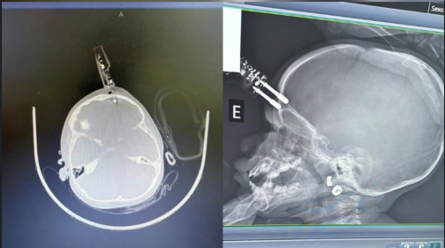 Bebê de 1 ano cai da cama e fica com carregador cravado na testa em MG