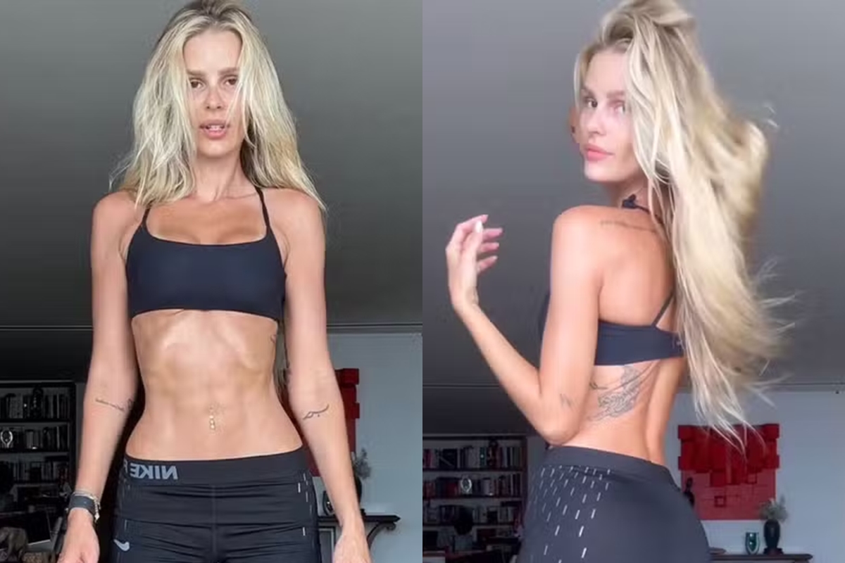 Antes e depois de Yasmin Brunet após tratar lipedema é impressionante