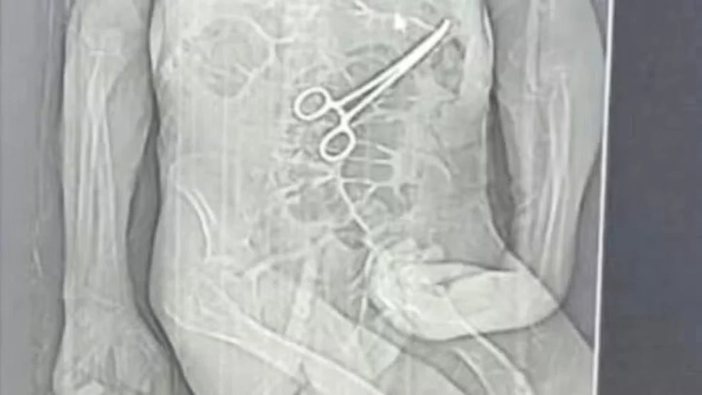 Homem morre após pinça ser esquecida no corpo em cirurgia