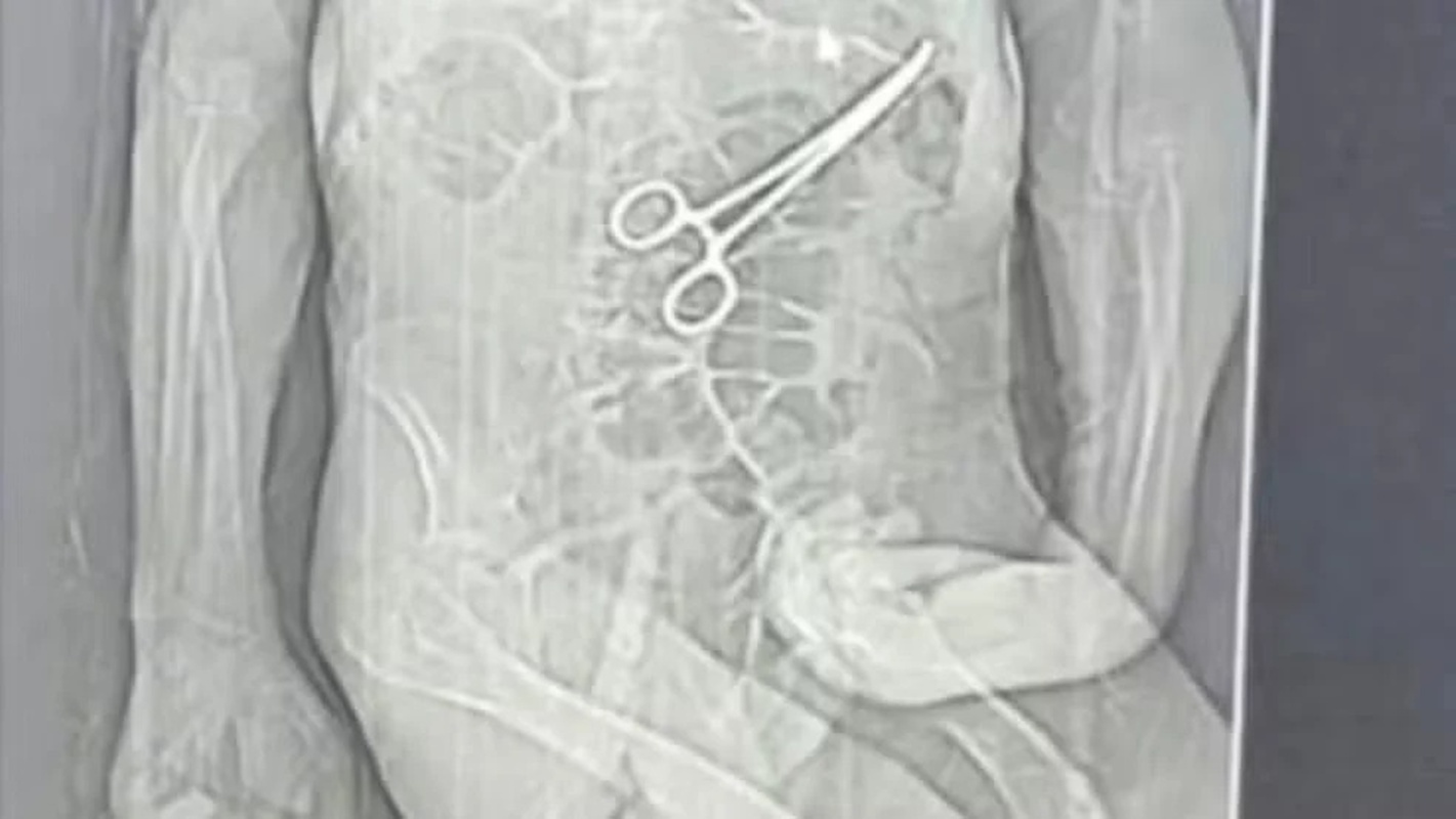 Homem morre após pinça ser deixada no corpo em cirurgia