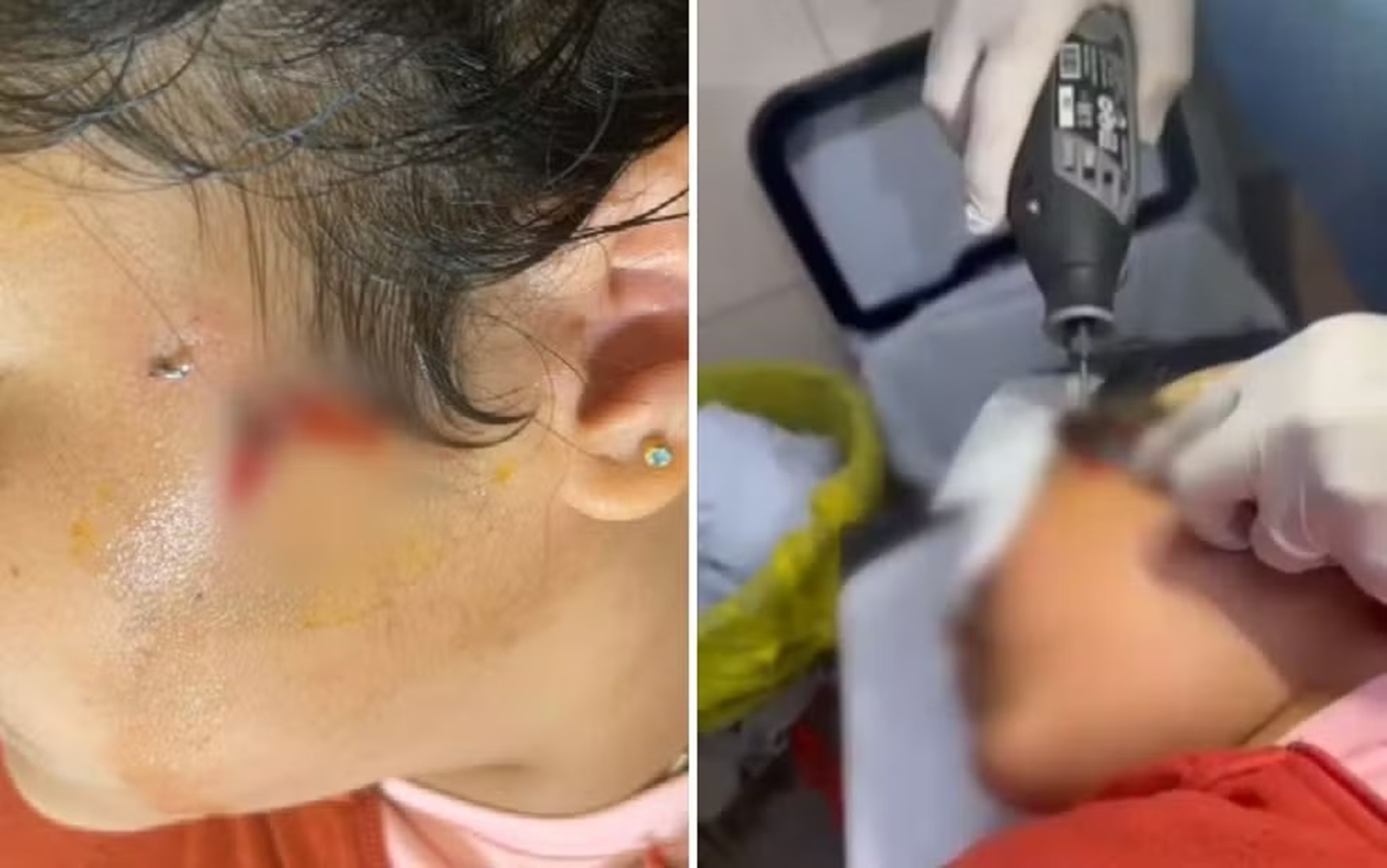 Menina fica com anzol preso na bochecha durante pescaria em GO. Veja o vídeo