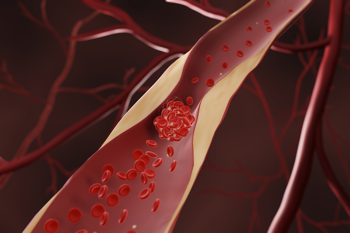 Médica vascular cita os 3 melhores suplementos benéficos à circulação