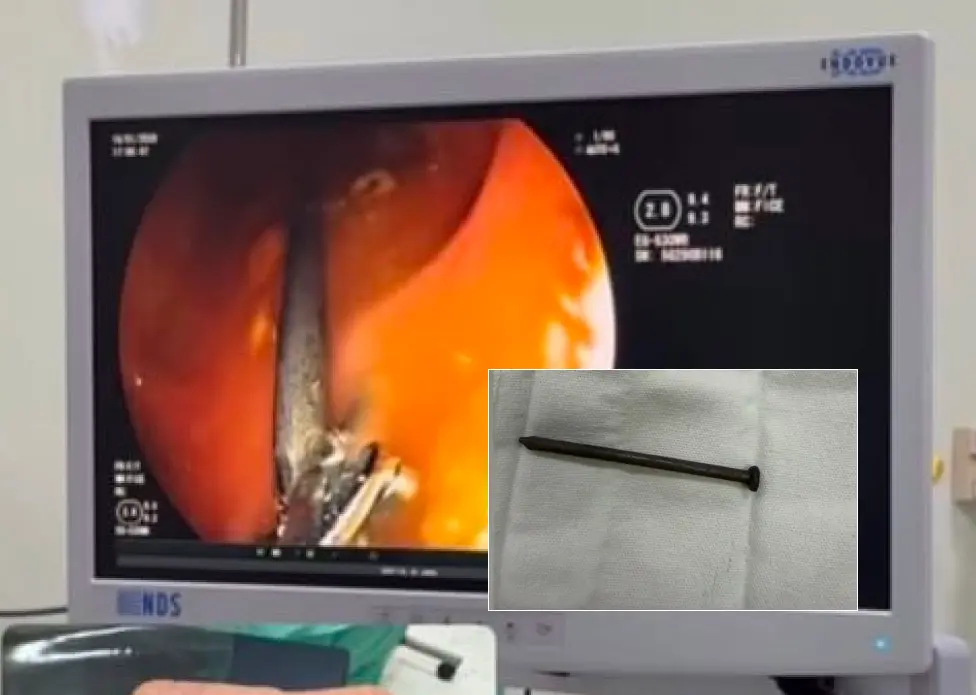 Prego é retirado do organismo de menino de 3 anos em Cruzeiro do Sul