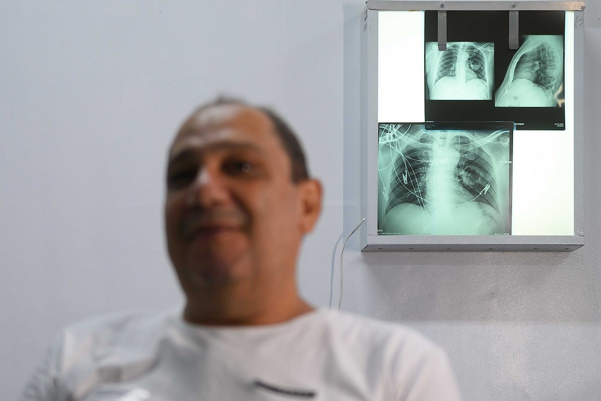 Doença fatal e subnotificada custou R$ 25,5 milhões ao SUS em 9 anos