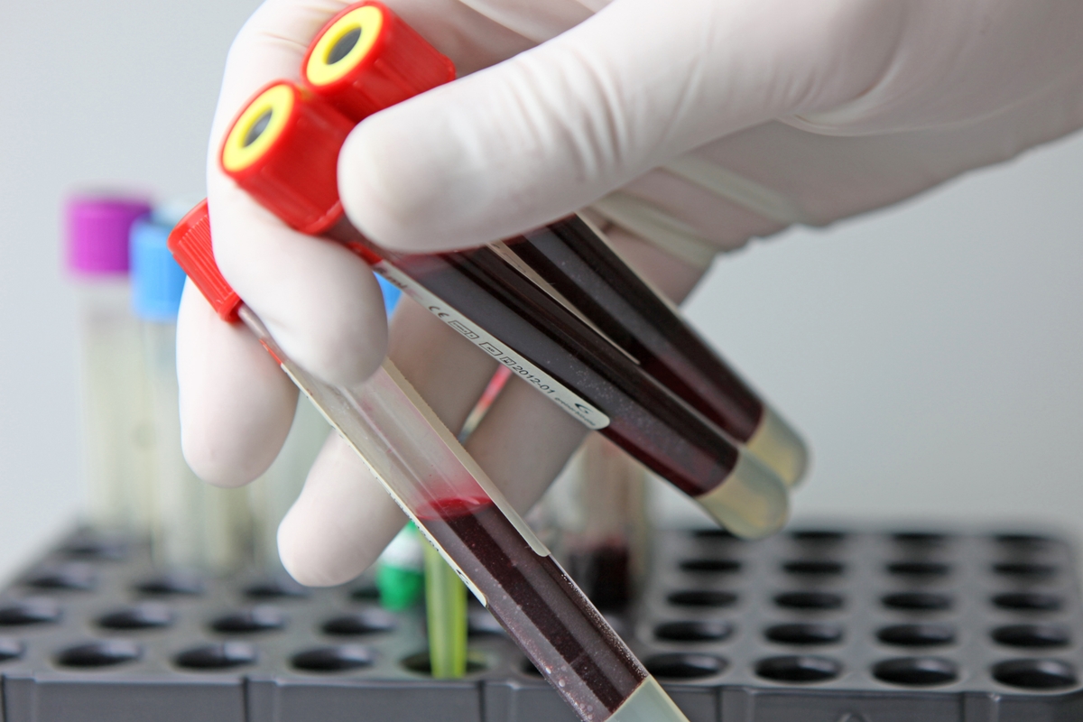 Sem respaldo, exames de sangue para câncer precoce se popularizam