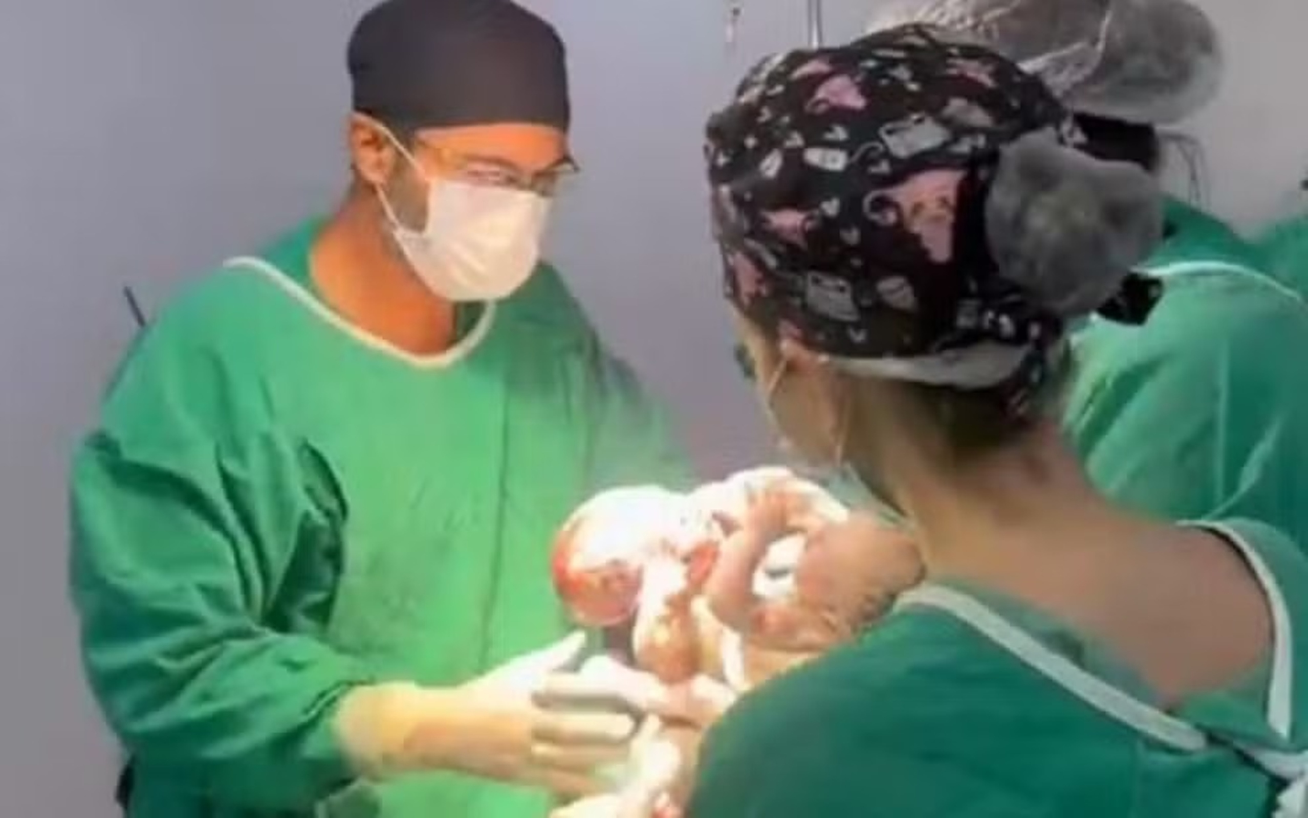 "Complexo", diz médico sobre siameses com 3 pernas que nasceram em GO