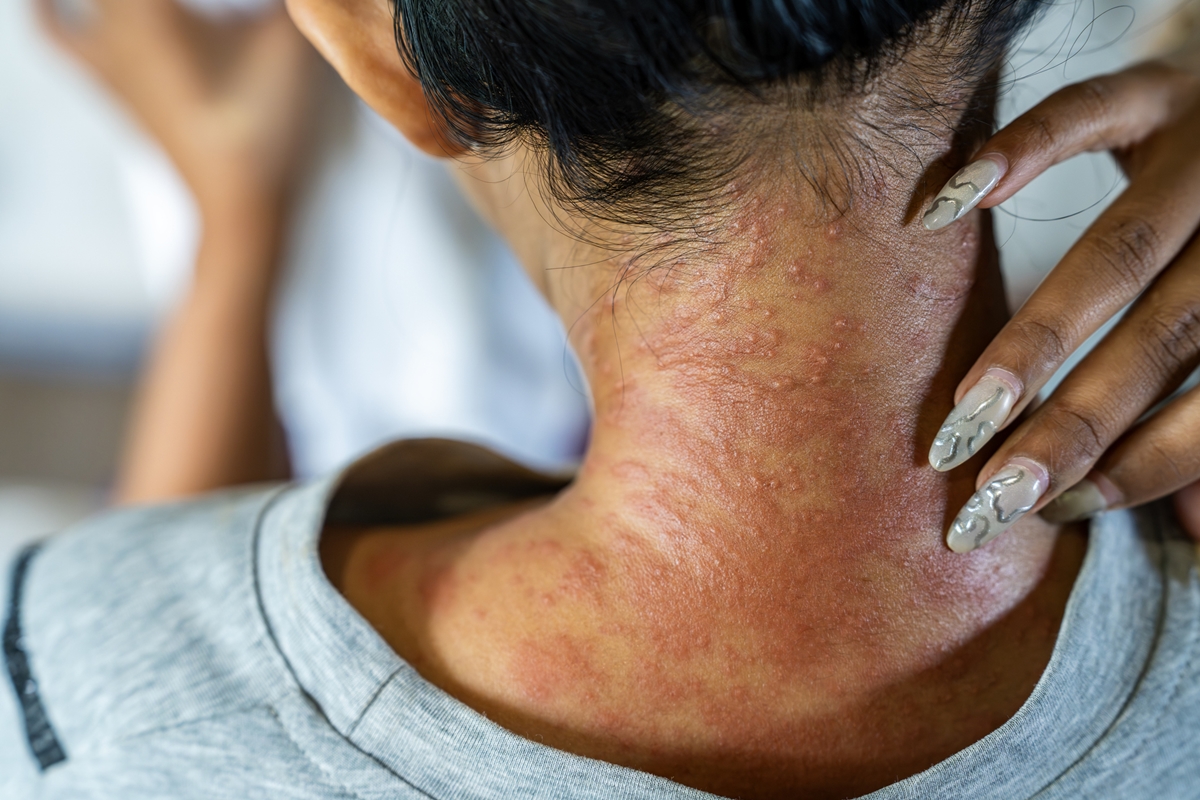 Dermatilomania: psiquiatra cita quando procurar ajuda para tratamento