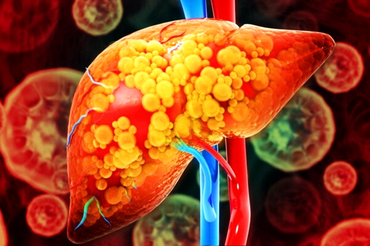 Hepatologista responde: toda gordura no fígado evolui para cirrose?