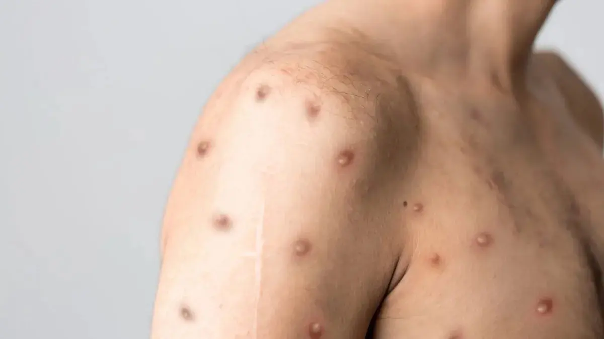 Rio Branco registra primeiro caso suspeito de Mpox; paciente é mulher e Vigilância acompanha