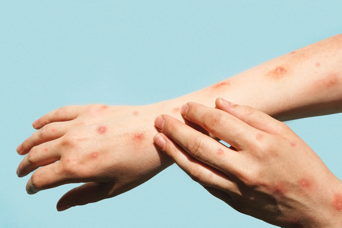 Mpox no DF: veja sintomas, tratamento e prevenção contra a doença